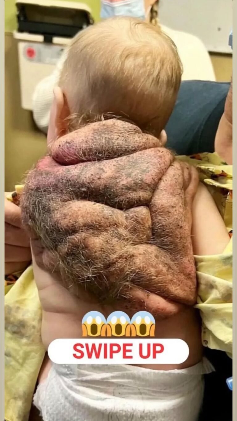 Her Little Superhero Was Born With His Own ‘Ninja Turtle Baby’ Shell