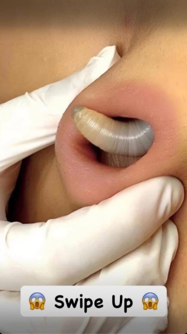 An enormous blackhead in the ear!